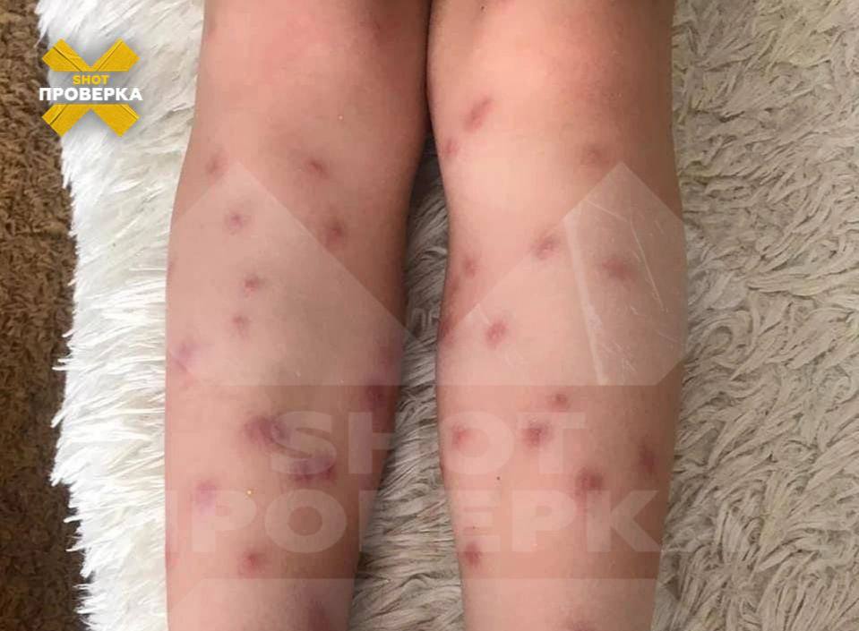 Россияне стали жаловаться на личинок червей, которые проникают под кожу во время купания | Российские водоемы заполнили личинки червей, которые проникают под кожу Россияне стали жаловаться на личинок червей, которые проникают под кожу во время купания | Российские водоемы заполнили личинки червей, которые проникают под кожу