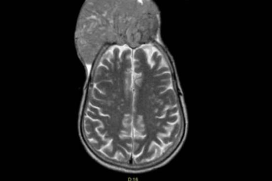 В Свердловской области медики спасли мужчину, у которого опухоль буквально «съела» череп | Медики провели 7-часовую операцию уральцу, чей череп «съела» менингиома 