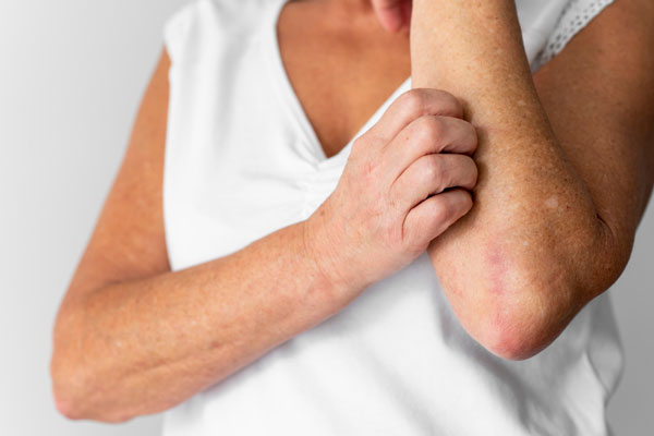 В деревне под Первоуральском детей атакуют блохи | В деревне Крылосово под Первоуральском массово жалуются на блох