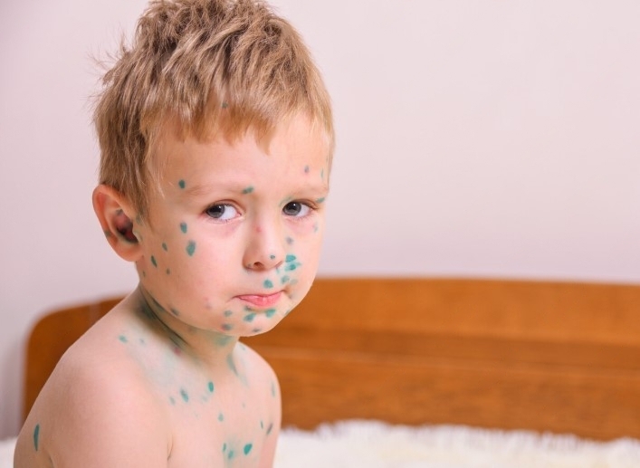 В Первоуральске выявили 91 случай ветрянки среди детей | В детской больнице Первоуральска обнаружили 91 случай заражения ветряной оспой